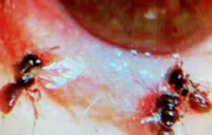 Doctors-Find-4-Live-Bees-Inside-Woman-s-Eye--Feeding-On-Her-Tears