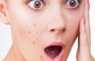Get-rid-of-acenes-home-remedy