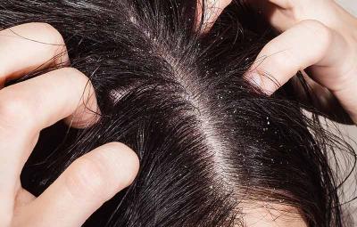 tips-to-cure-dandruff-by-using-baking-soda