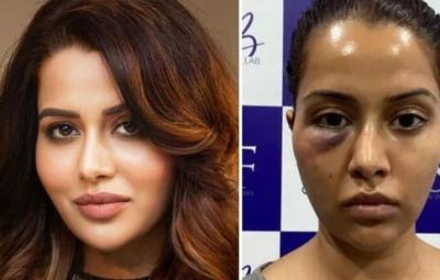 raiza-wilson-face-surgery-goes-wrong