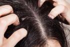 tips-to-cure-dandruff-by-using-baking-soda