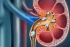 how-can-i-prevent-kidney-stone