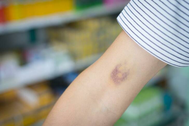 Low Platelet Count!.jpg
